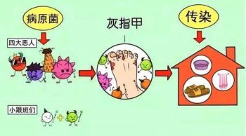 灰指甲是怎样引起的